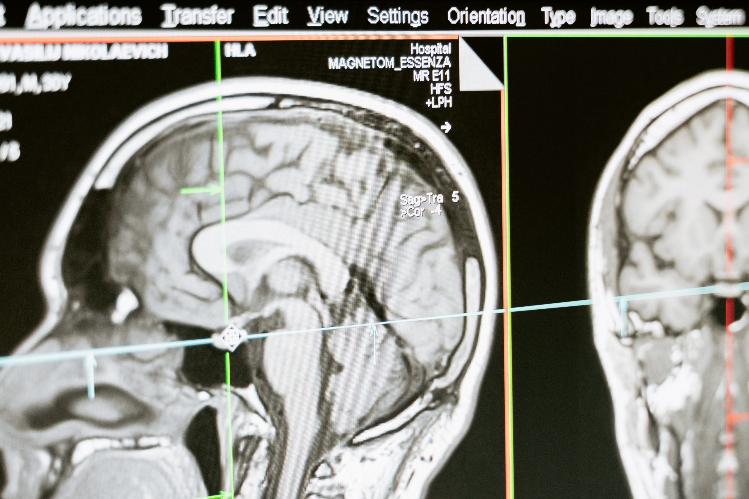 mon chemin vers un diagnostic de sclérose en plaques